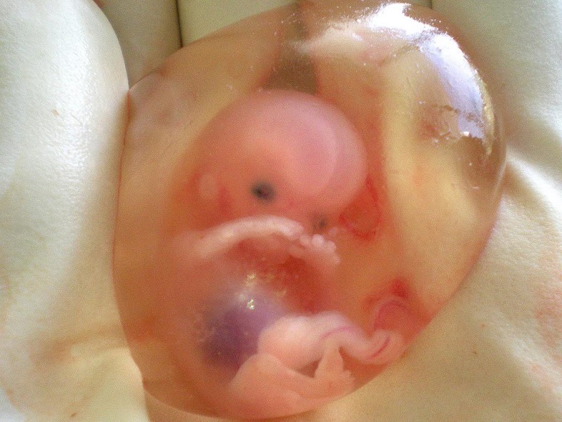 10weeksunbornbaby2