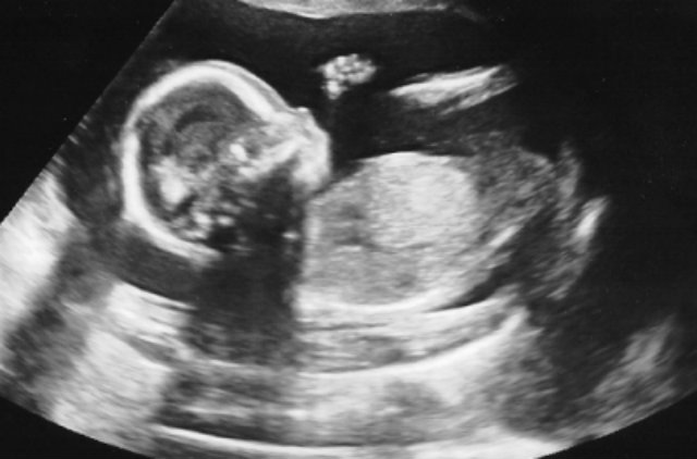 4d-ultrasound-demon