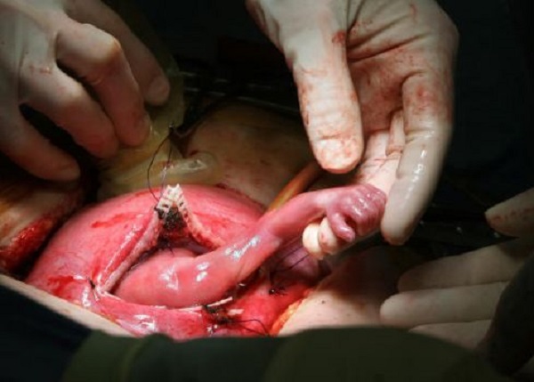 fetalsurgery4